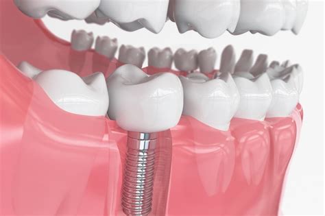 Yttrium Oxide: Biocompatible Marvel for Bone and Dental Implants?